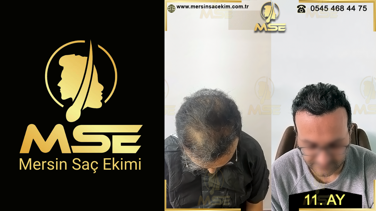 MERSİN SAÇ EKİMİ